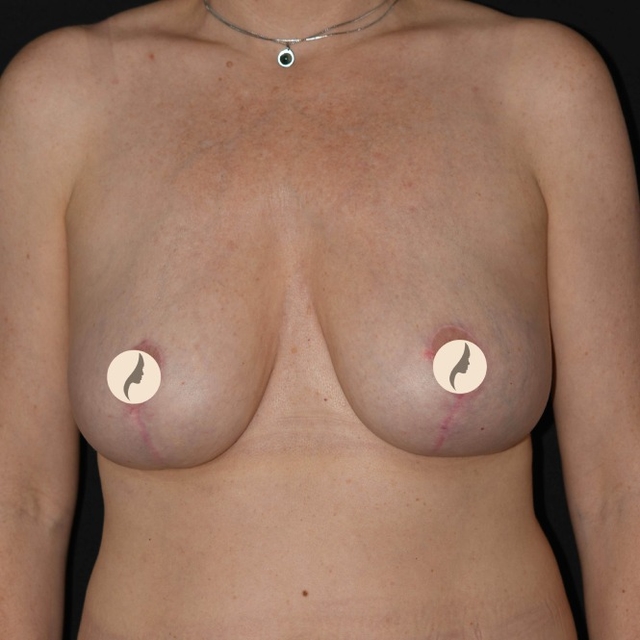 Bröstreduktion, bröstförminskning