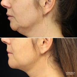 Fettsugning av hals inklusive fettransplantation samt huduppstramning med Renuvion - före och efter Fettsugning av hals inklusive fettransplantation samt huduppstramning med Renuvion - före och efter