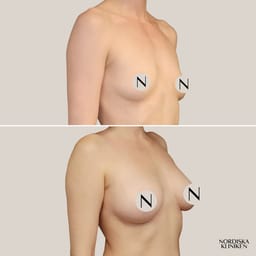 NK Light bröstförstoring med implantat - före och efter NK Light bröstförstoring med implantat - före och efter