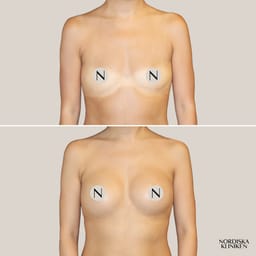 Bröstförstoring med implantat - före och efter Bröstförstoring med implantat - före och efter