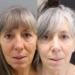 Primär näsplastik hos 69 åring Primär näsplastik hos 69 åring