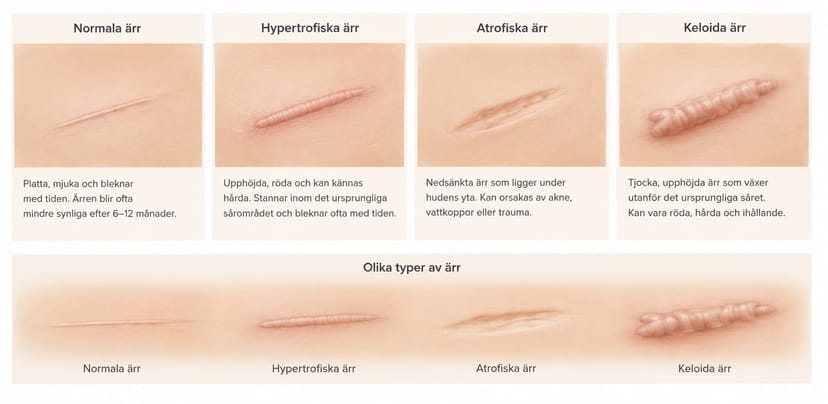 Fula ärr - vad kan man göra? Fula ärr - vad kan man göra?