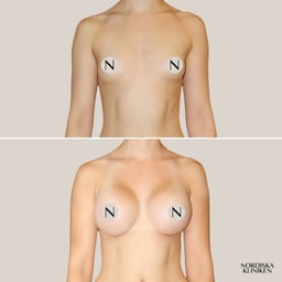 Bröstförstoring med implantat - före och efter Bröstförstoring med implantat - före och efter
